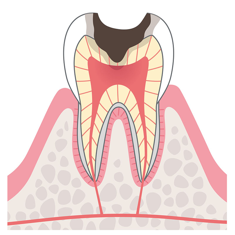 C2 象牙質の虫歯